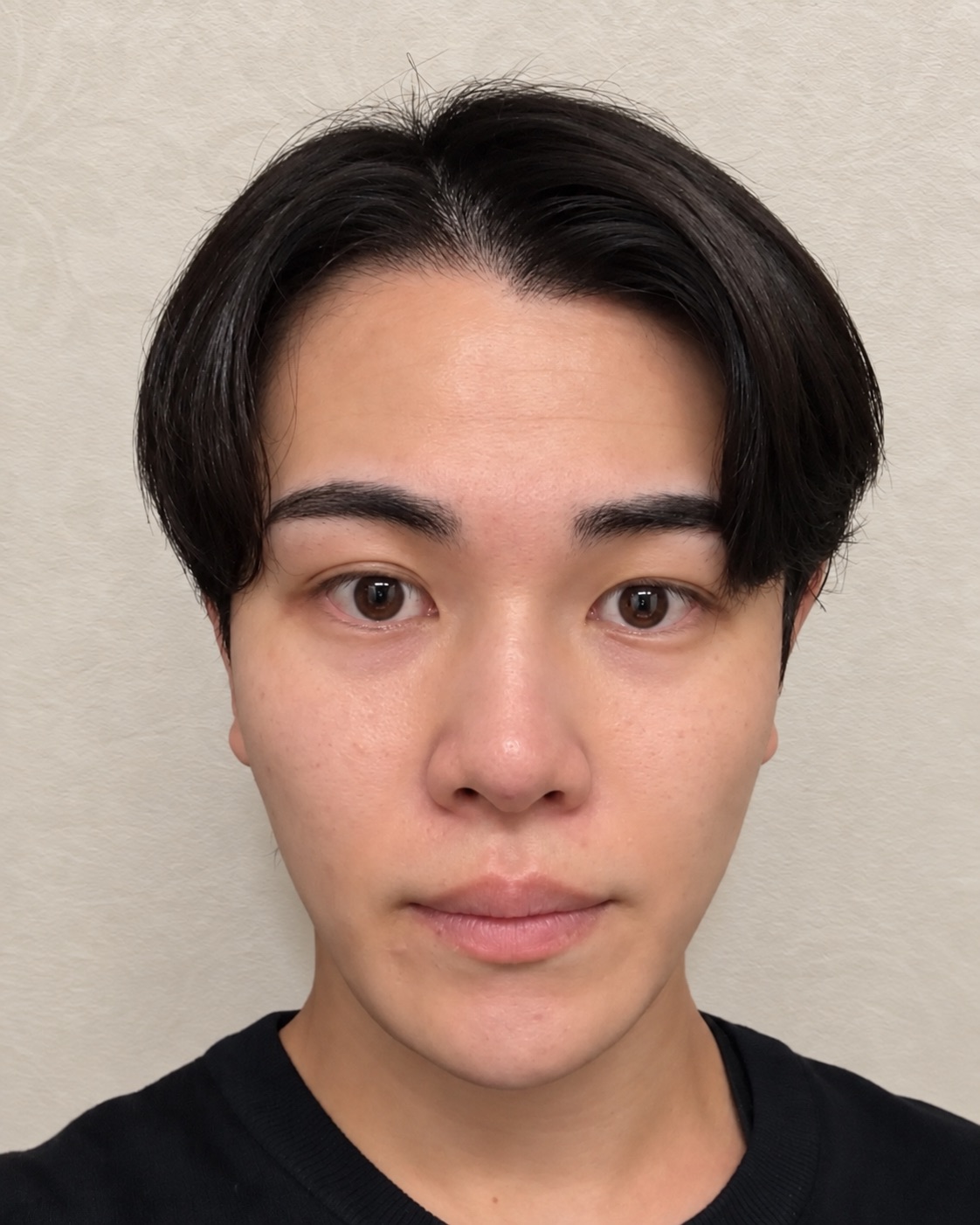 鼻糸リフト（鼻柱6本・鼻翼3本） 施術当日・0日後