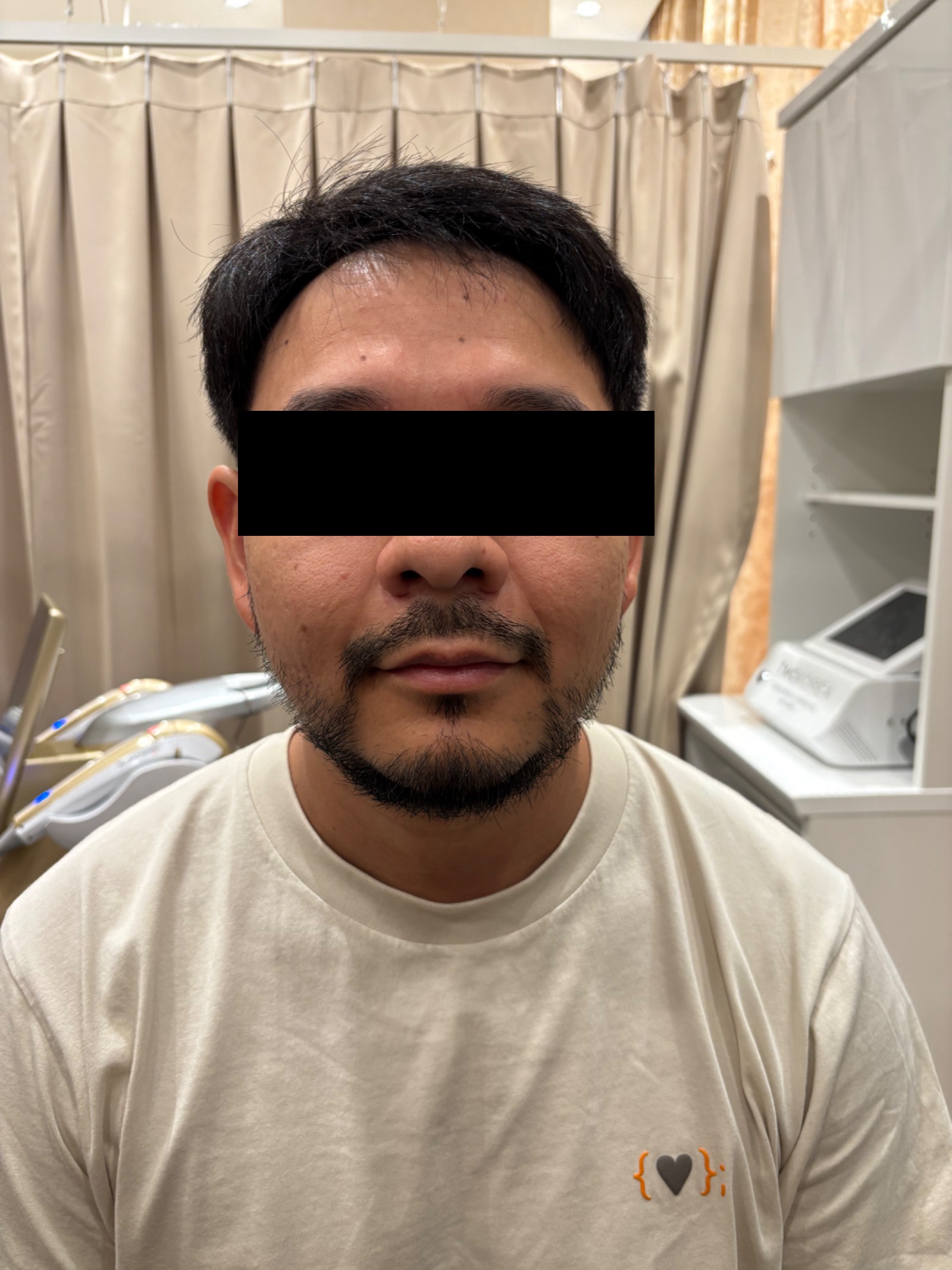 ULTRATHERMA HIFU・EMS＋ハイドラフェイシャル 施術前