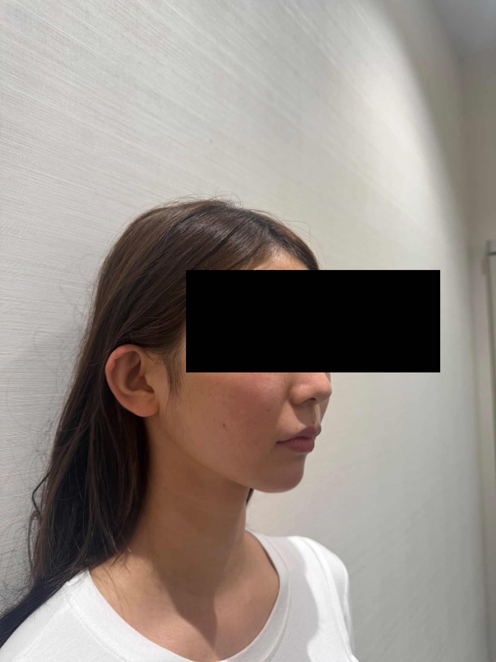 唇ヒアルロン酸・HIFU・ジェネシス併用 施術前